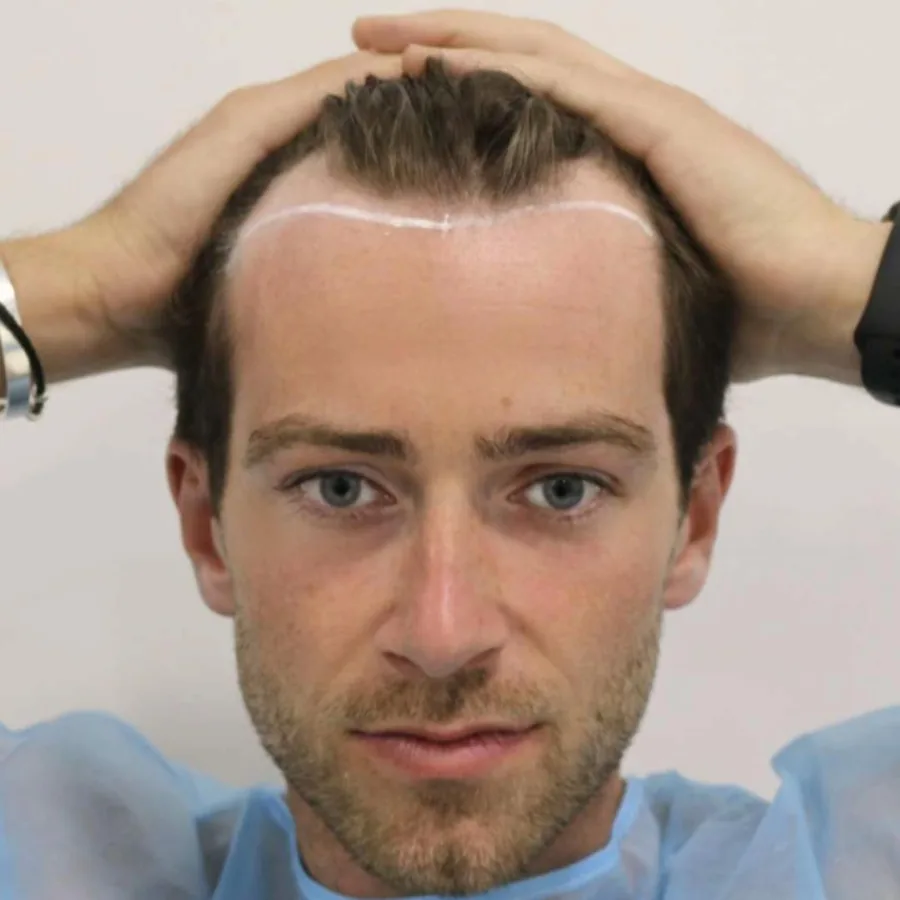 Digby Edgley's receding hairline before his FUE hair transplant
